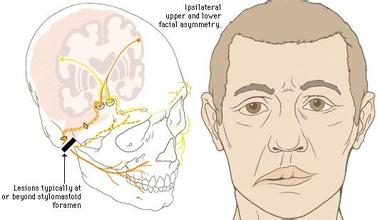 面瘫后遗症